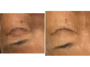 アストリア(ASTORIA)/リブセラフェイシャル