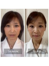 ハッピービューティーサロン じゆう(Happy Beauty Salon J∞YOU)/人気No.1/魔法の小顔矯正/1回目
