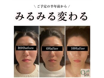 キュープ 鹿児島西陵店(Qpu)/回数を重ねる度に変化が