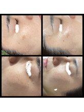 ココスタイルビューティー(COCOSTYLE beauty)/シミ改善し放題