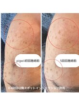 モフ(mof.)/シミケアでお肌のトーンアップ