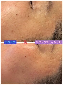 プリュネル(Prunelle)/プラズマシャワー&シミケア