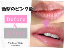 Yui Clear Skinの雰囲気(【ヴィーナスピンク】唇や胸の黒ずみを除去し赤ちゃんピンクに)