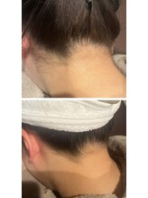 インフィニティ ビューティサロン 姫路店(INFINITY beautysalon)/脱毛