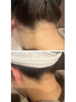 インフィニティ ビューティサロン 姫路店(INFINITY beautysalon)/脱毛