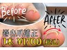 【新メニュー】フット巻爪補正　導入キャンペーン　1本 【片足】