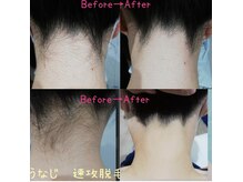 RiとBiのたまご/（脱毛）うなじ脱毛・襟足脱毛