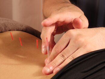 北船岡整骨院 イオン船岡店/鍼通電療法