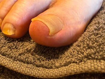 歩っとけあの写真/【巻き爪でお困りの方必見】丁寧なカウンセリングで長年の爪の悩みを改善！BSスパンゲ矯正取扱店☆