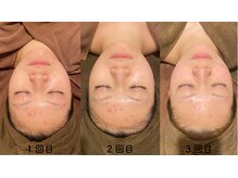 ビュップ 鶴ヶ峰店(美up)/ララピールフェイシャル