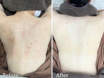 エステ ニキビケア研究所 川崎店/ 背中ニキビケアも◎