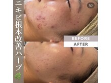 アトリエリン 小牧本店(Atelier Rin)/ハーブピーリング