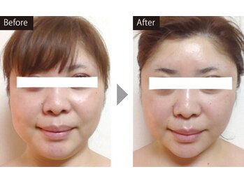 ファウンデーション(FOUNDATION)/ハイパーナイフお顔1回目症例