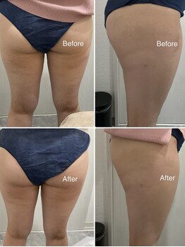 セラス(CERAS)/フォスカッター　ふくらはぎ30分