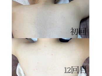 サロン ルーシュ(salon ruche)/脱毛(背中)