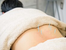 ハリキー(鍼×KEY)/