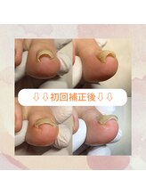 かとり台整骨院 つくば/巻き爪補正
