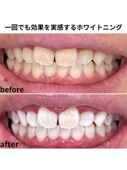 ソエルテ(soerute)/ホワイトニング