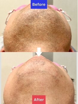 フィズ 国分寺店(FIS)/ヒゲ脱毛