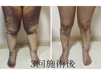 ミカド 銀座(mikado)/太もも吸引 before after