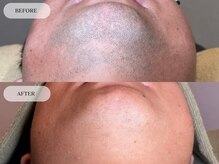 メンズプラス(MEN’S PLUS)/ヒゲ脱毛/ビフォーアフター写真