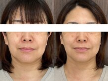 シミケア専門店 SAKURA 平塚店/【平塚/シミケア/たるみケア】