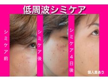 スプーンサロン(SPOON SALON)の雰囲気(サロン一押しシミケア)