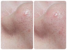 トータルビューティ ノイド(Noid)/毛穴洗浄　いちご鼻撃退