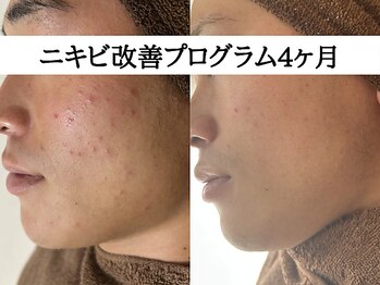 アエオボンヌール(A.E.O BONHEUR)/繰り返す細かいニキビ改善