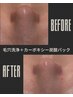 水素水を使用した毛穴洗浄【ハイドロスプラッシュ！】￥9,800→￥6,800