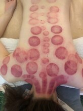 中国整体 らくらく堂/温熱療法吸い玉デトックス