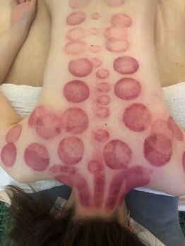 中国整体 らくらく堂/温熱療法吸い玉デトックス