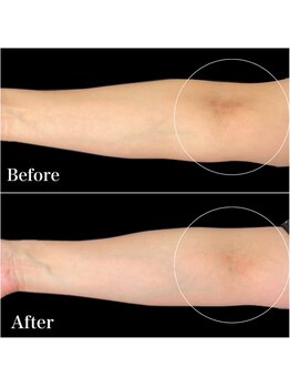 リブ(Lib)/脱毛に日焼けは危険!!