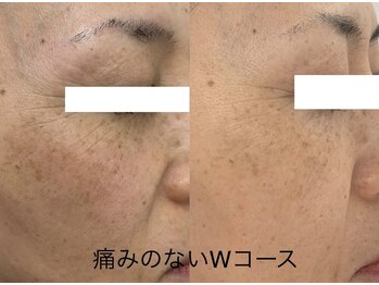 サクラ 伊勢原店(SAKURA)/フェイシャルエステ以上の効果