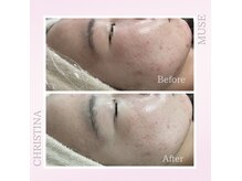 シャルムパリス(charme paris)/敏感肌を強く！１回の施術変化