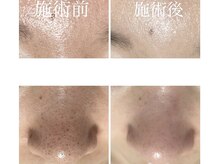 毛穴塾/ハイドラ毛穴洗浄☆