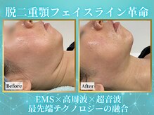 リメイクビューティークリニック(REMAKE BEAUTY CLINIC)の雰囲気（脂肪撃退マシンハイイーム・ハイジーオで切らない小顔造形）