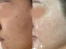 エヌエースキン 北谷店(NAskin)/ハーブピーリング｜美白ケア