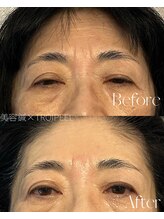 ルミア(LUMiA)/おでこの横ジワ・眉間のシワ改善