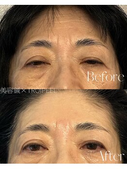 ルミア(LUMiA)/おでこの横ジワ・眉間のシワ改善