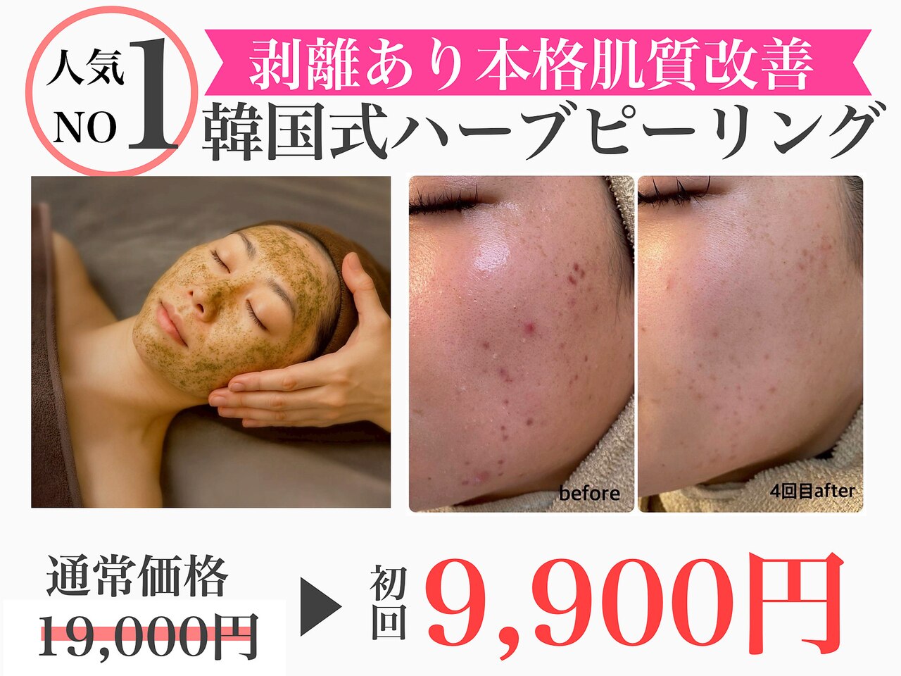 岡山】剥離ありのハーブピーリングができるサロン一覧ができるサロン一覧