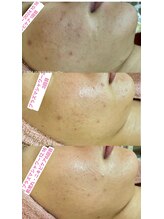 エレガンテ(ELEGANTE)/モニター様1クール（6回）写真