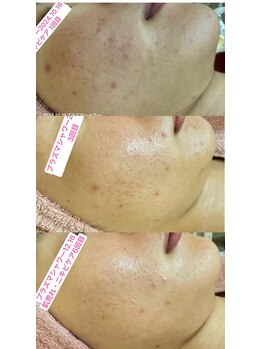 エレガンテ(ELEGANTE)/モニター様1クール（6回）写真