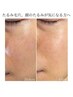 【2回目限定】フェイシャル脱毛WAX+ヘッドスパ（+30分）¥14600→￥13300