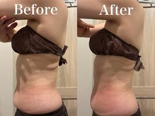 モリタ鍼灸整骨院/【ラジオ波】ボディメイク