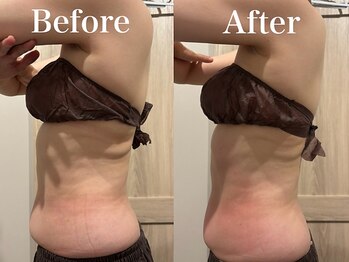 モリタ鍼灸整骨院/【ラジオ波】ボディメイク