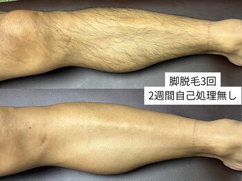 メンズ脱毛 千歳/脚脱毛3回&自己処理無し！