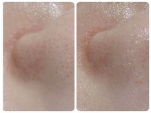 トータルビューティ ノイド(Noid)/毛穴洗浄　いちご鼻撃退