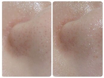 トータルビューティ ノイド(Noid)/毛穴洗浄　いちご鼻撃退