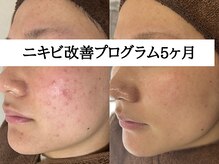 アエオボンヌール(A.E.O BONHEUR)/何年も繰り返すニキビ改善